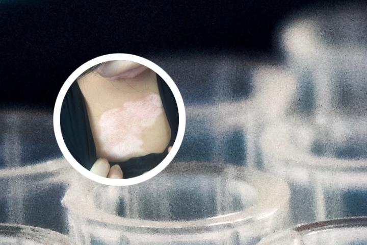 发散型白癜风