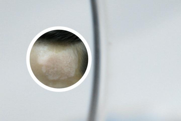 白癜风周围有红晕