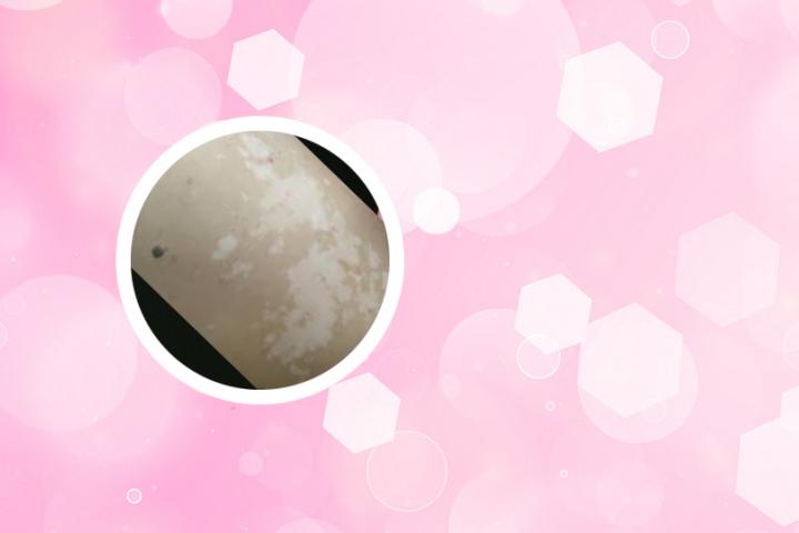 本草纲目治疗白癜风