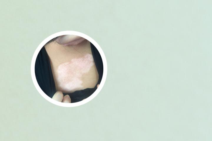 白癜风有治好的方法么