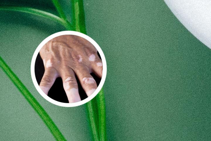 治白癜风的药膏白色的盒
