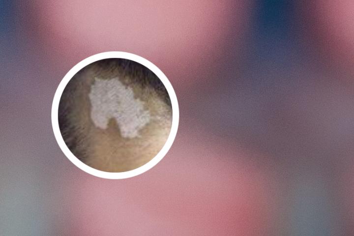 白癜风和牛皮癣有什么不同