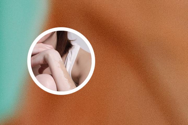 硬皮病和白癜风
