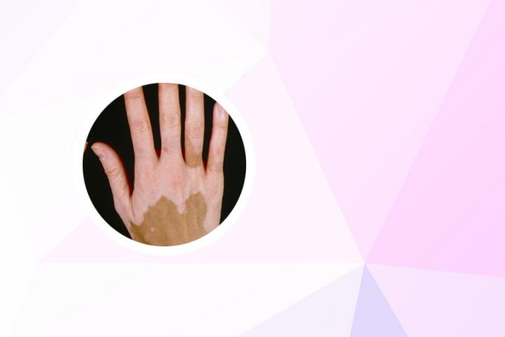 如何用蒺藜治白癜风