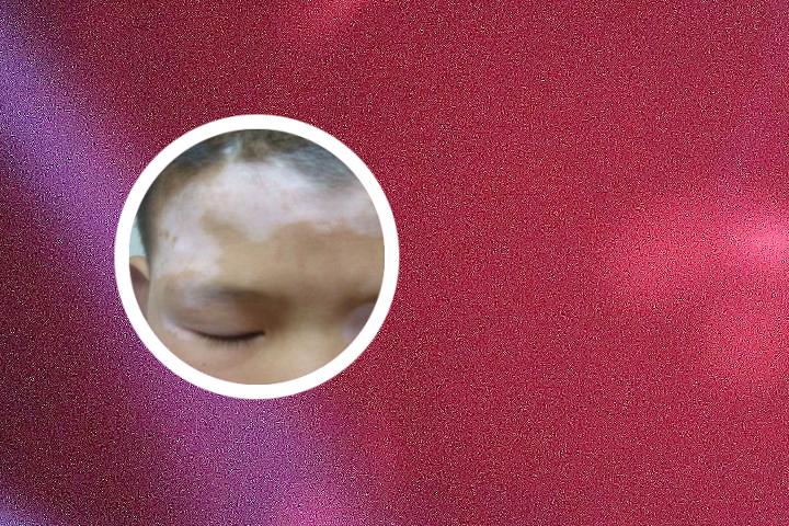 化疗后怎么治疗白癜风