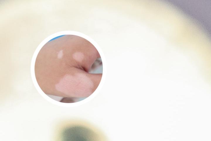 小孩患白癜风几率大么