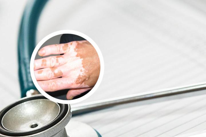 医学上怎么区分白癜风