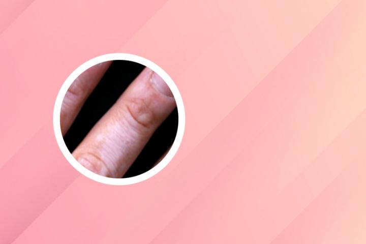 白癜风症状