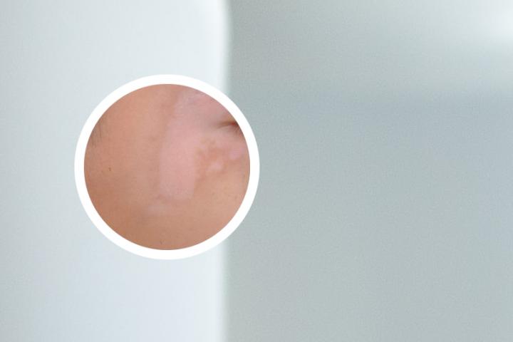治疗白癜风多久出现色素点