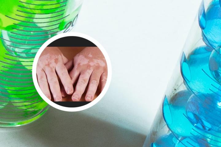 白癜风恶化表现
