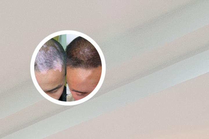 喝酒导致白癜风扩散怎么治疗