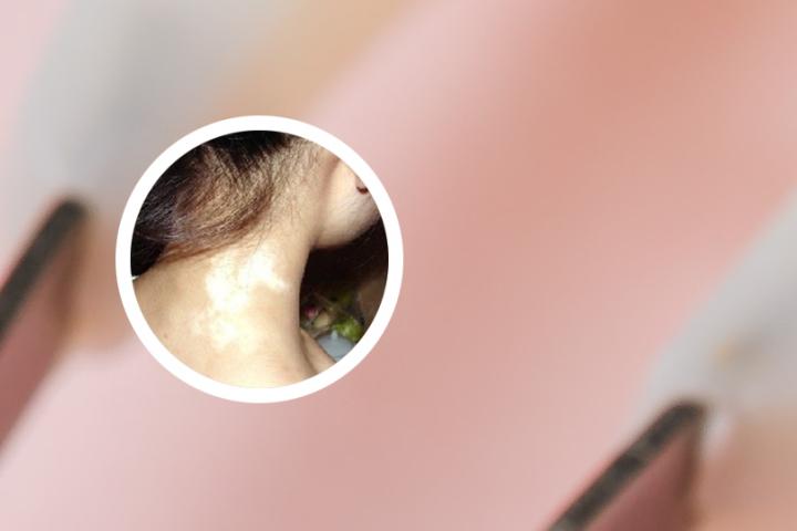 白癜风治疗期间宜吃莴笋吗
