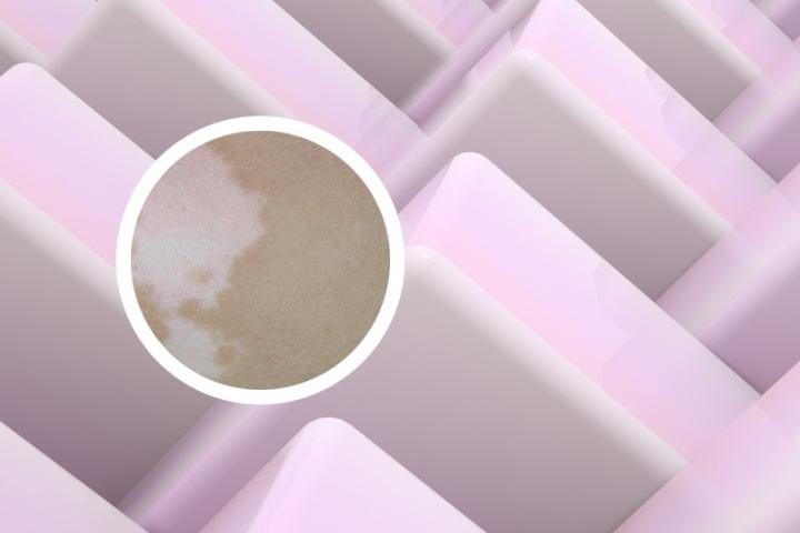 江西白癜风传染病图片