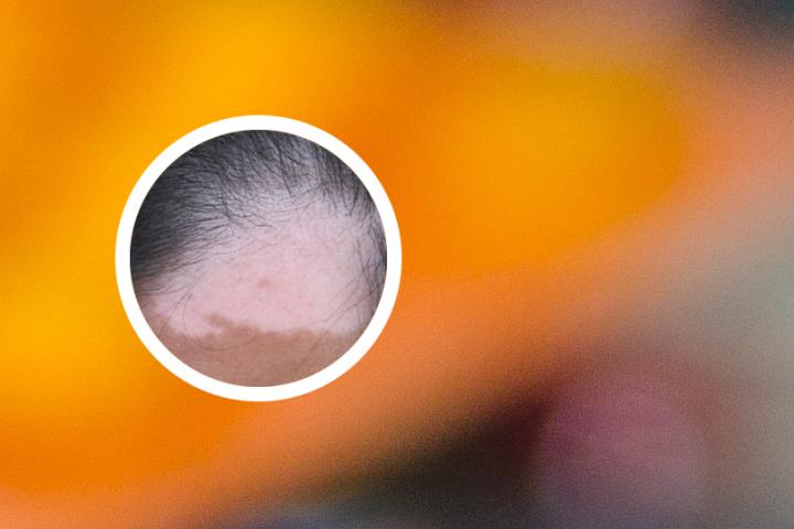 太原哪里治白癜风效果最好