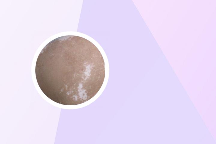 湿疹引起的白癜风如何治疗