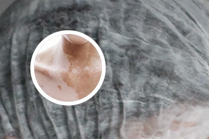 生殖器白癜风症状