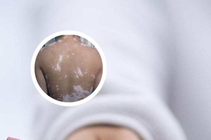 女宝遗传白癜风怎么办