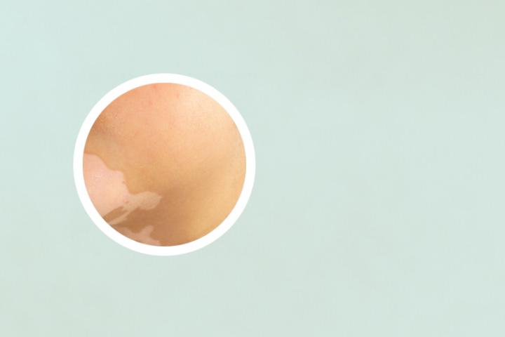 白癜风为啥 白癜风为啥不能吃维生素c