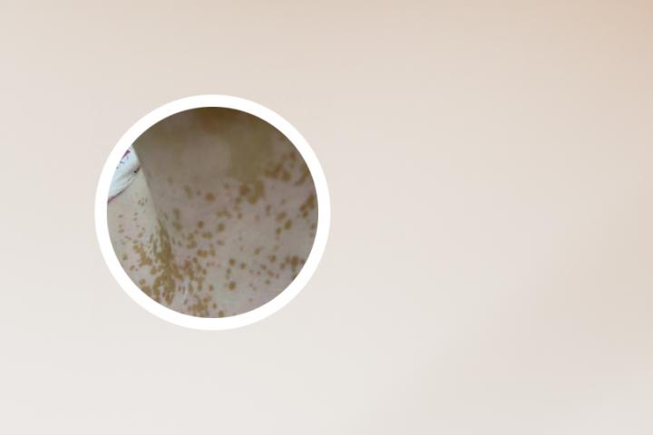 得白癜风之前有什么症状