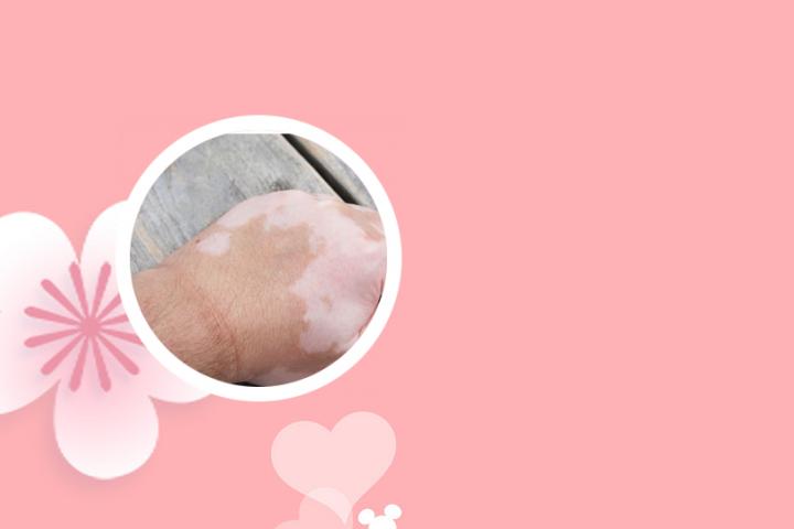 白癜风和心脾两虚有关吗