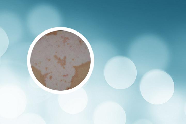 白癜风维生素c能吃么 白癜风维生素c能吃吗