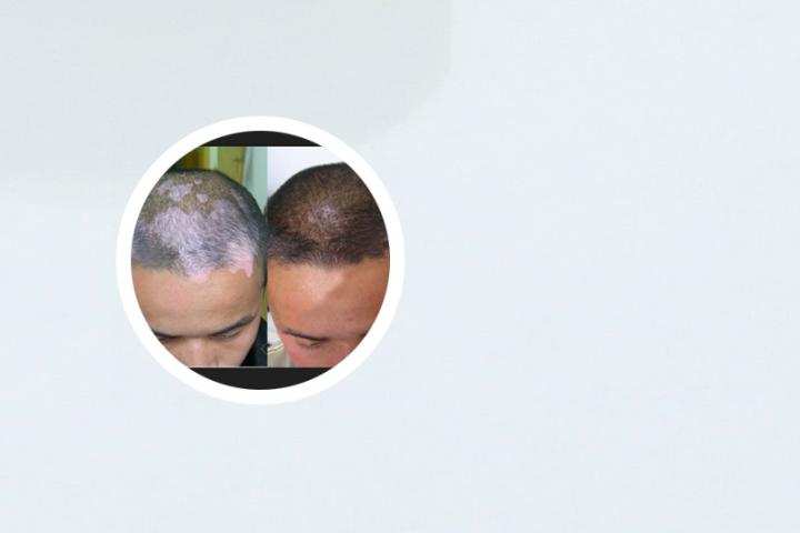 白癜风长在头发里怎么办