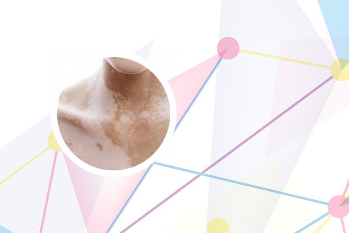 烟雾中生白癜风