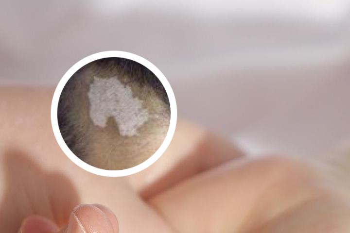 白癜风抗复发最新消息