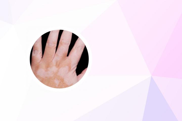 日照哪里有治疗白癜风的