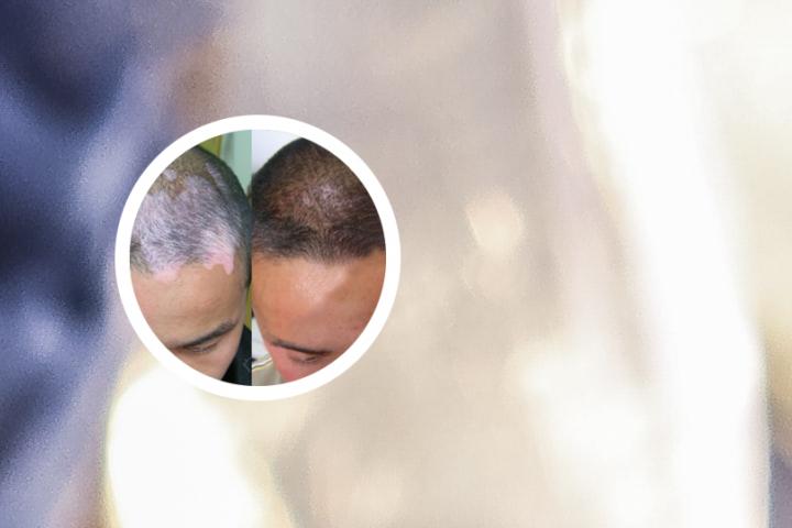 白癜风晚上睡觉痒不 白癜风晚上睡觉会抽搐