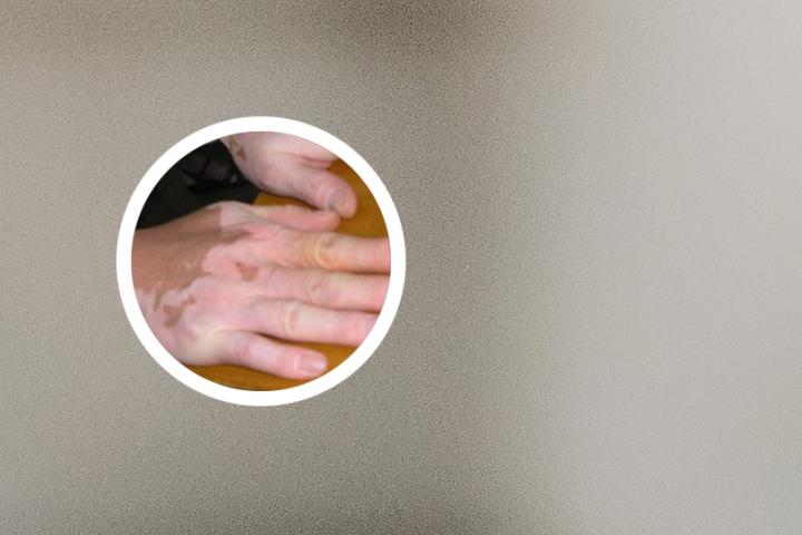人参皂苷对白癜风