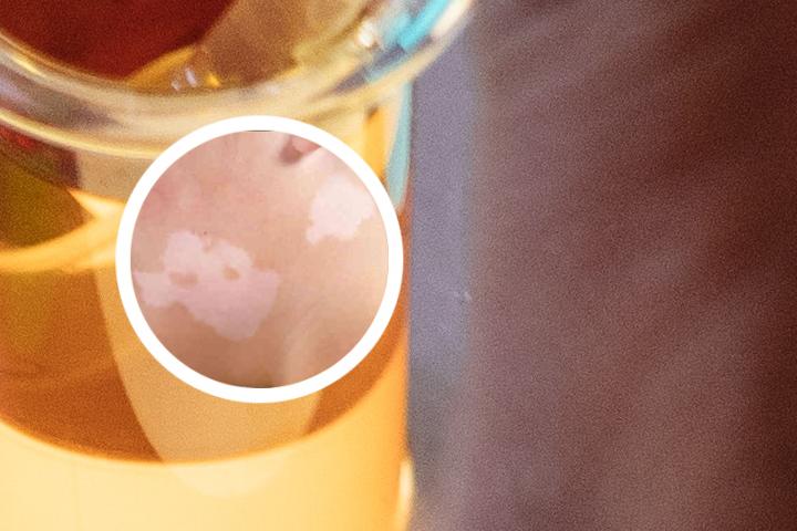孕期白癜风能喂母乳吗