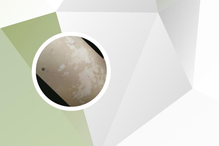 白癜风308治疗能中断吗
