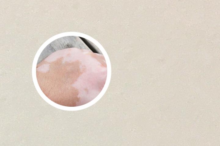 白癜风手掌有白点