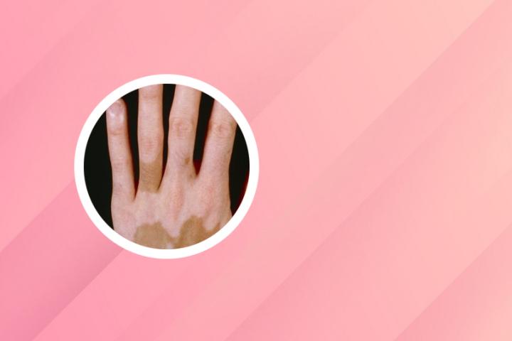 长春治疗白癜风医院网站