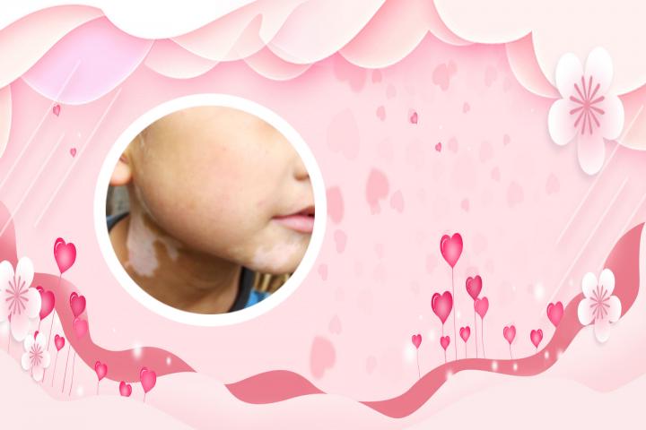 吃健脾丸治疗白癜风