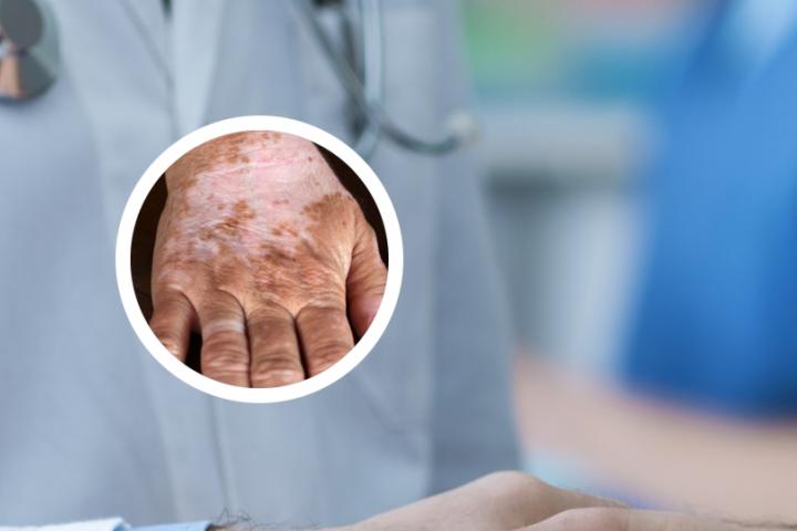 白癜风完全变白变成白人