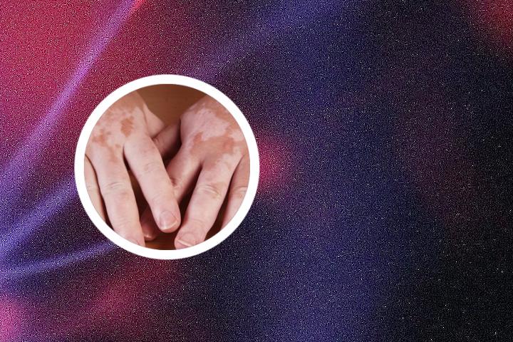 新生儿白癜风怎么处理