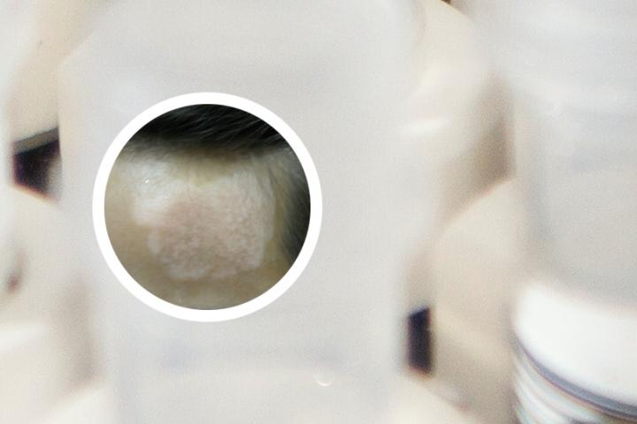 嘉峪关白癜风专科医院排名