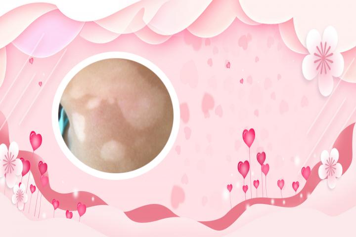 得白癜风之前有什么征兆吗