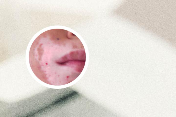 白癜风患者癌变率