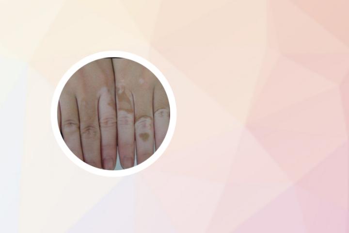 血液溶血会得白癜风吗