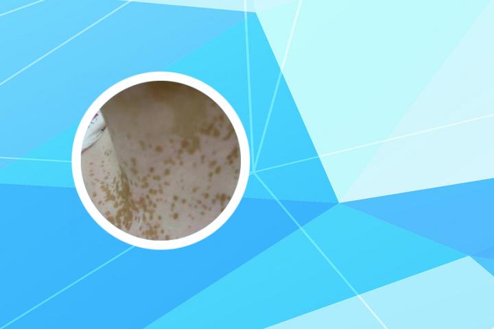 茄子花可以抹白癜风
