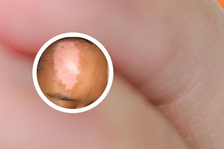 哪里买治白癜风药
