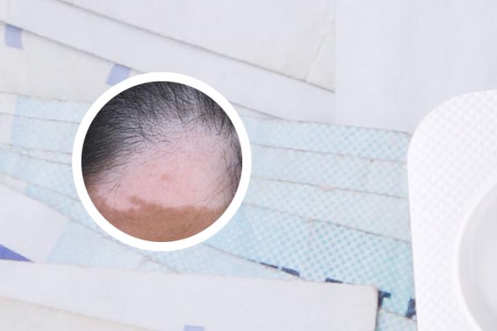 白癜风晚期还能活多久