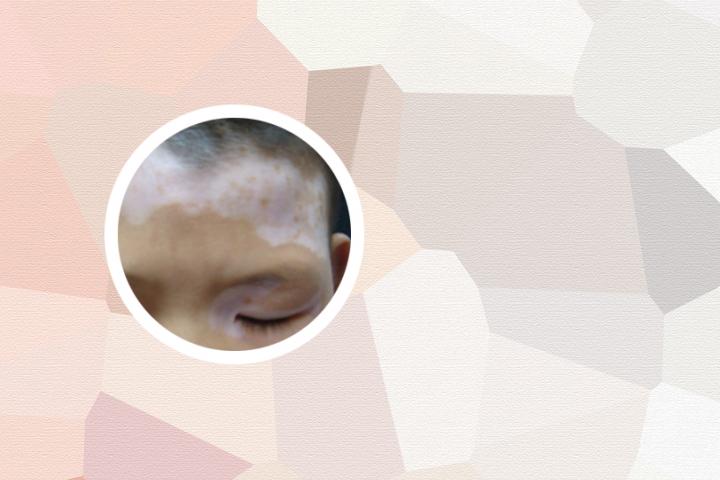 儿童白癜风辨别