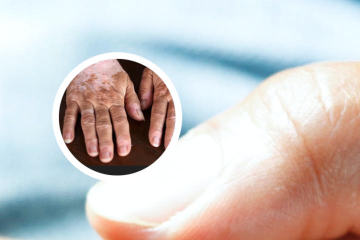汕尾治白癜风哪家最好