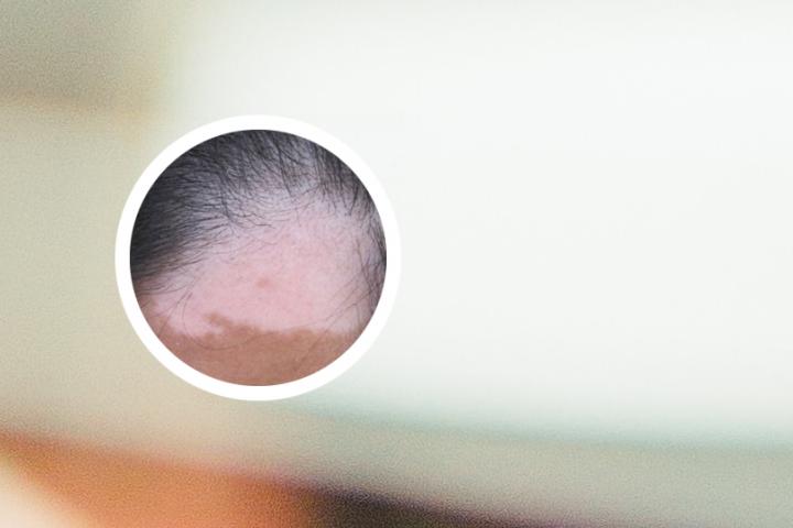 白癜风治疗过程博主