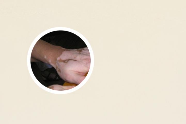白癜风在脸上可以按摩吗