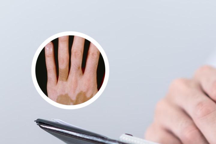 白癜风患者在生活中做什么